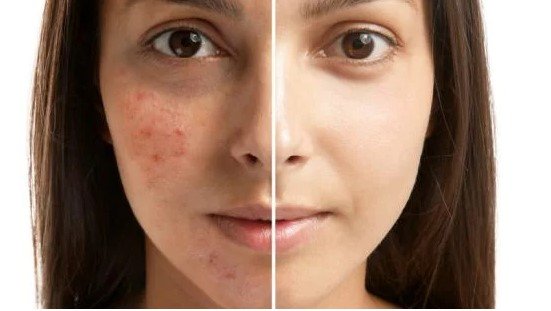 Acne will affect the majority of people at some point in their lives