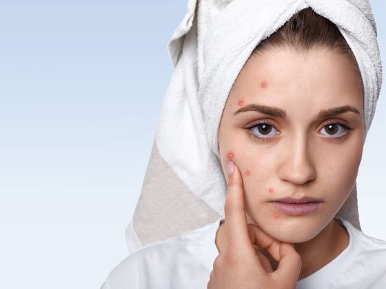 Although many people are worried about acne-removing products, prevention may actually be more crucial to take into account. After all, prevention is always preferable to treatment. Here are five of the most fundamental yet crucial methods for treating and preventing acne buildup.