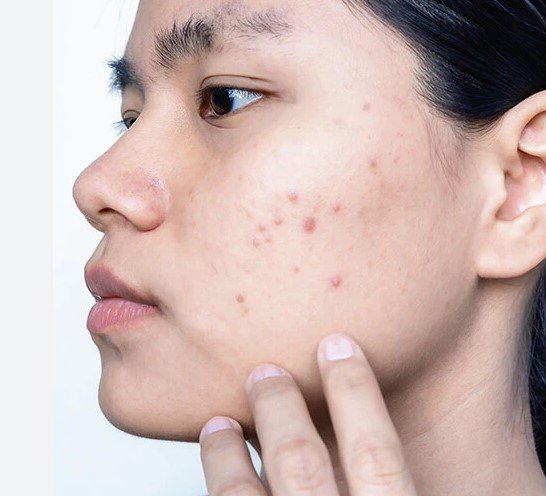 Many people who have acne have a tendency to withdraw from society and actively choose not to interact